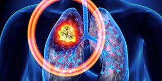 Breast Cancer Breast Cancer Breast Cancer